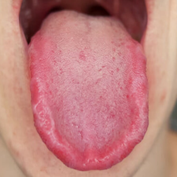 Audio Article: Burning Mouth Syndrome - The Dental Hygienist’s Role in Assessment and Treatment