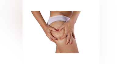 image for Understanding Cellulite: Insights from a Cosmetic Chemist and Esthetician