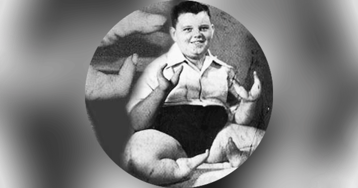 62. Lobster Boy - Grady Stiles, Jr.